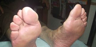 Escasez de medicamentos contra la diabetes supera el 90% en Venezuela